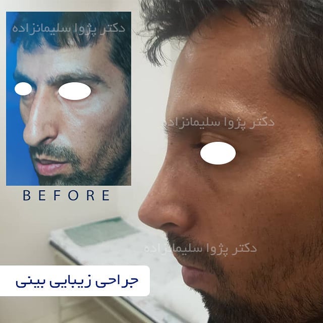 جراحی بینی مردانه